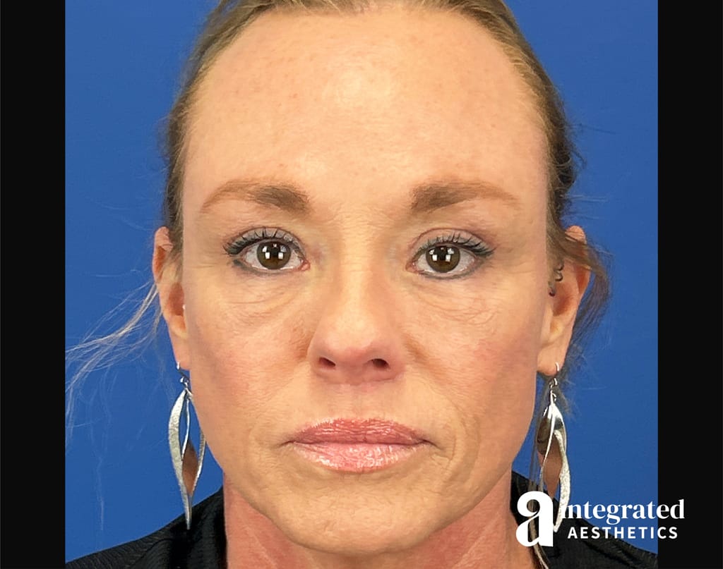 Facial Combined Procedures