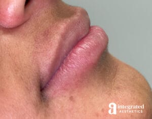 Lip Filler