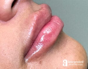 Lip Filler