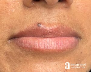 Lip Filler
