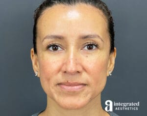 Dermal Fillers