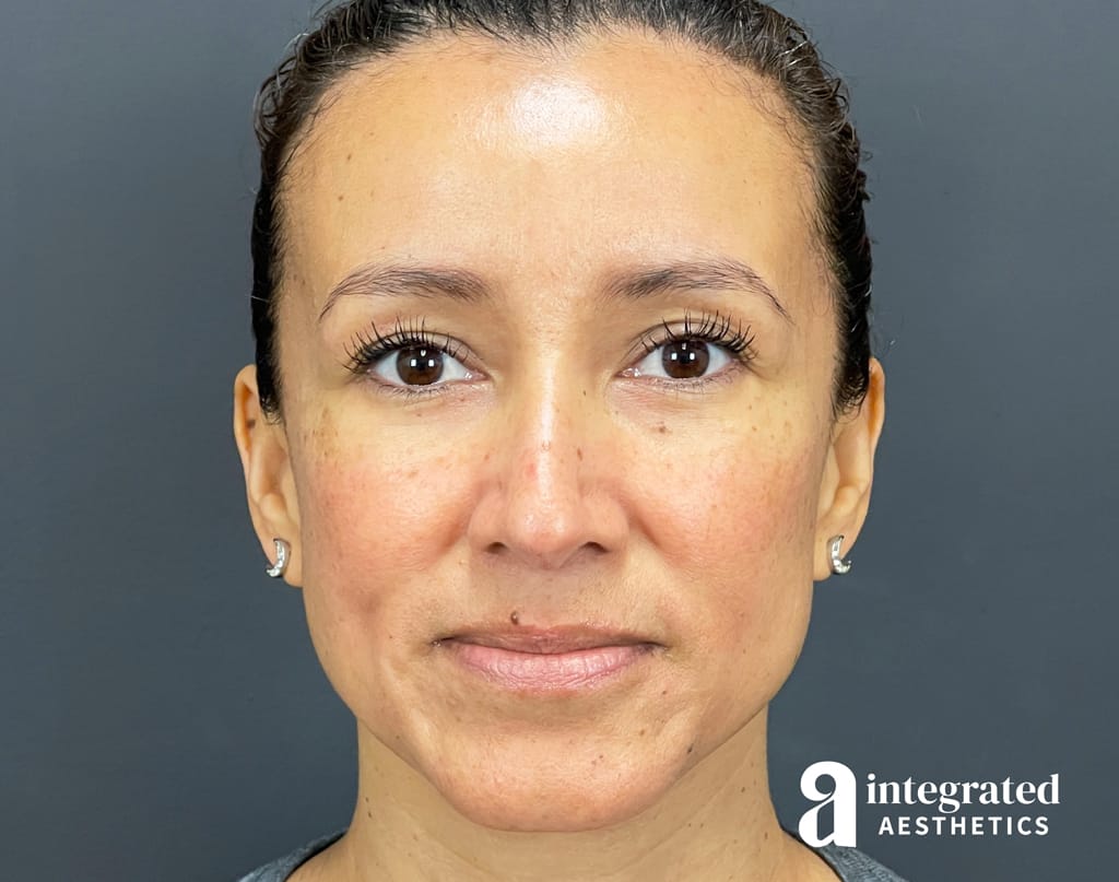 Dermal Fillers