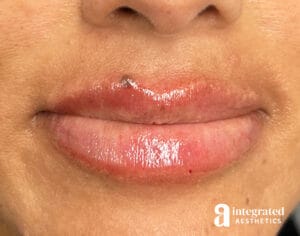 Lip Filler