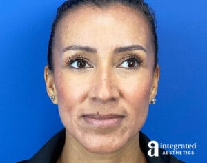 Dermal Fillers