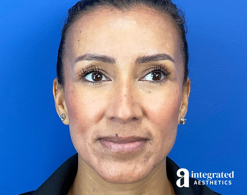 Dermal Fillers