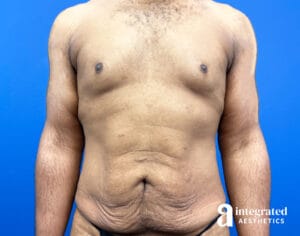 Tummy tuck, Liposuction & Fat Transfer