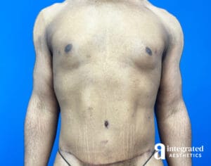 Tummy tuck, Liposuction & Fat Transfer