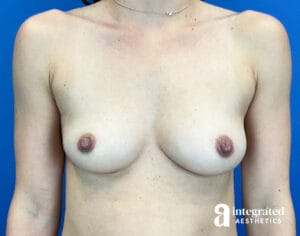 Breast Augmentation