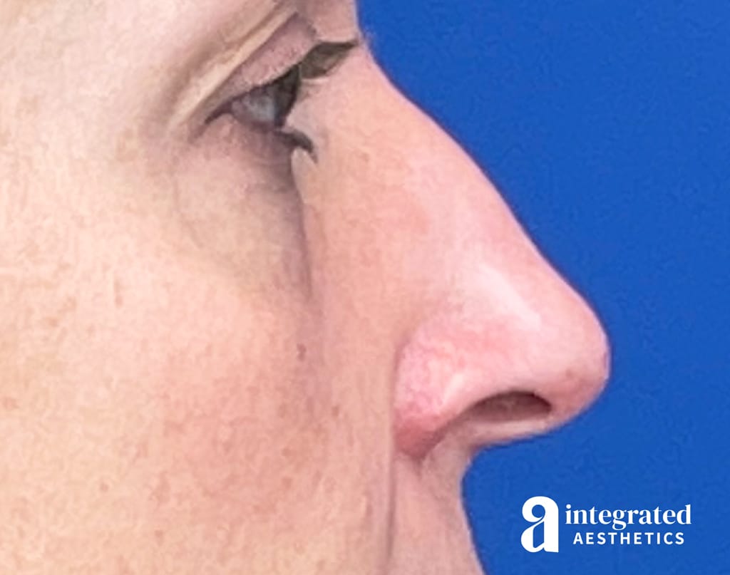 Liquid Rhinoplasty
