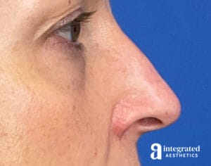Liquid Rhinoplasty
