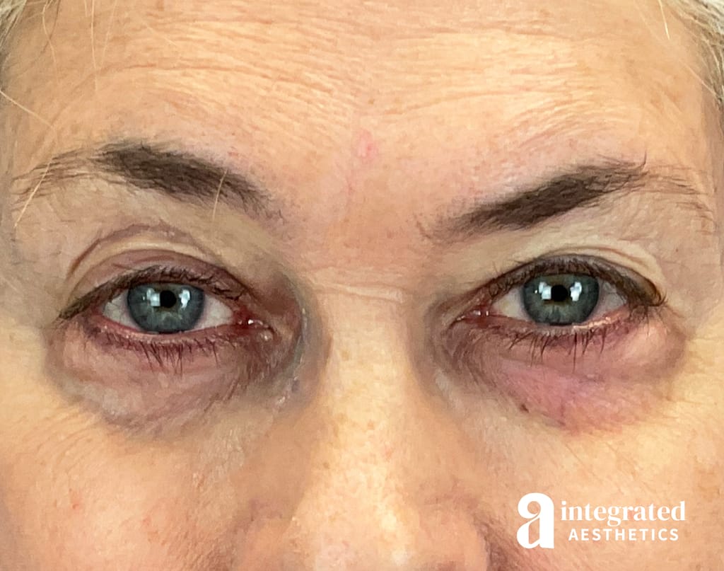 Blepharoplasty