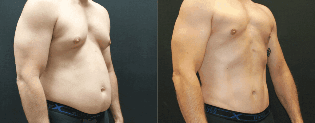 Male patient before and after a tummy tuck at Integrated Aesthetics