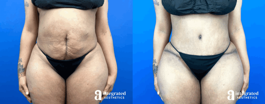 Female patient before and after a tummy tuck with Dr. Cho at Integrated Aesthetics