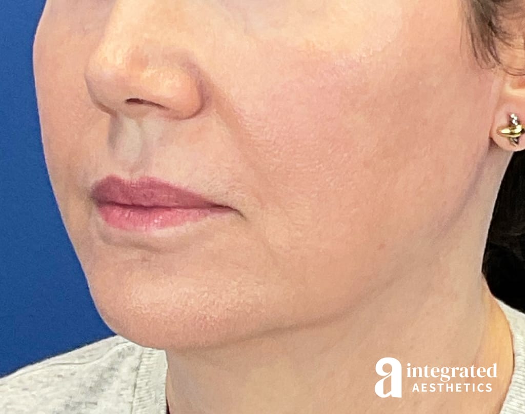 Dermal Filler Jawline
