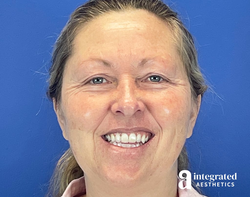 Non-Surgical Blepharoplasty and Deep Chemical Peel