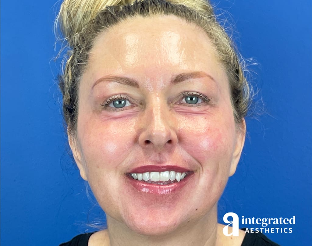 Non-Surgical Blepharoplasty and Deep Chemical Peel