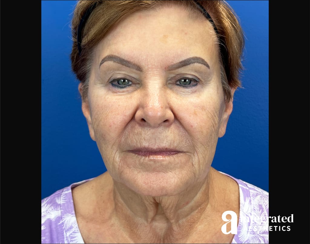 Facial Combined Procedures