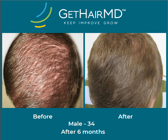 Before and after non-surgical hair restoration with GetHairMD