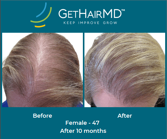 Before and after non-surgical hair restoration with GetHairMD