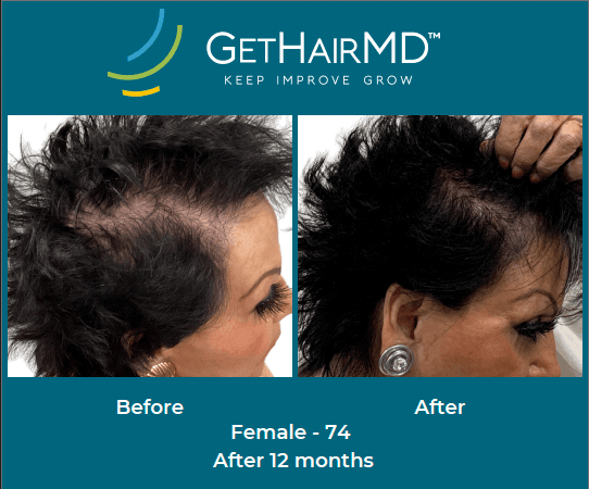 Before and after non-surgical hair restoration with GetHairMD