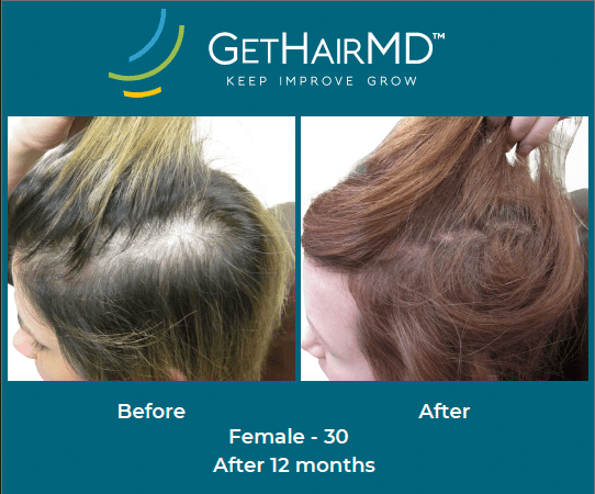 Before and after non-surgical hair restoration with GetHairMD