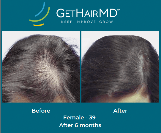 Before and after non-surgical hair restoration with GetHairMD