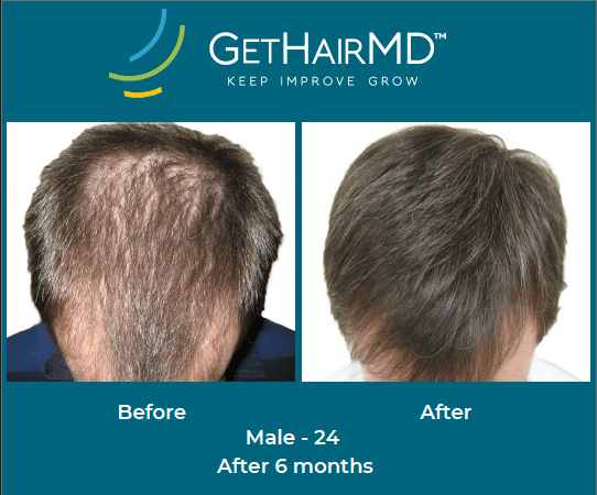 Before and after non-surgical hair restoration with GetHairMD