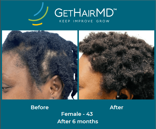 Before and after non-surgical hair restoration with GetHairMD