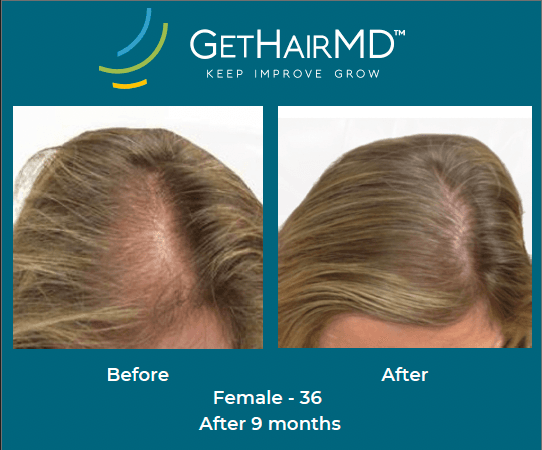 Before and after non-surgical hair restoration with GetHairMD