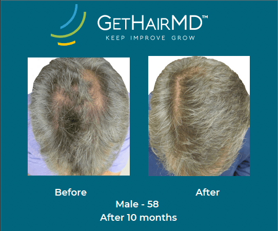 Before and after non-surgical hair restoration with GetHairMD