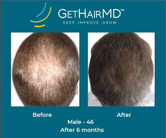 Before and after non-surgical hair restoration with GetHairMD