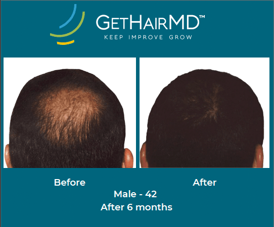 Before and after non-surgical hair restoration with GetHairMD