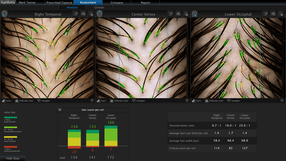 GetHairMD Hair Metrix Analysis