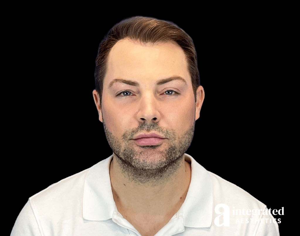 Resolved Aesthetic Complications