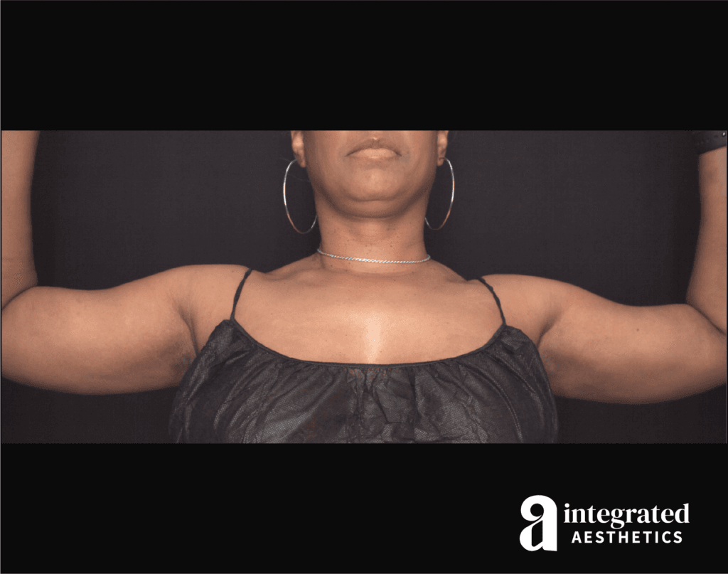 Liposuction and BodyTite