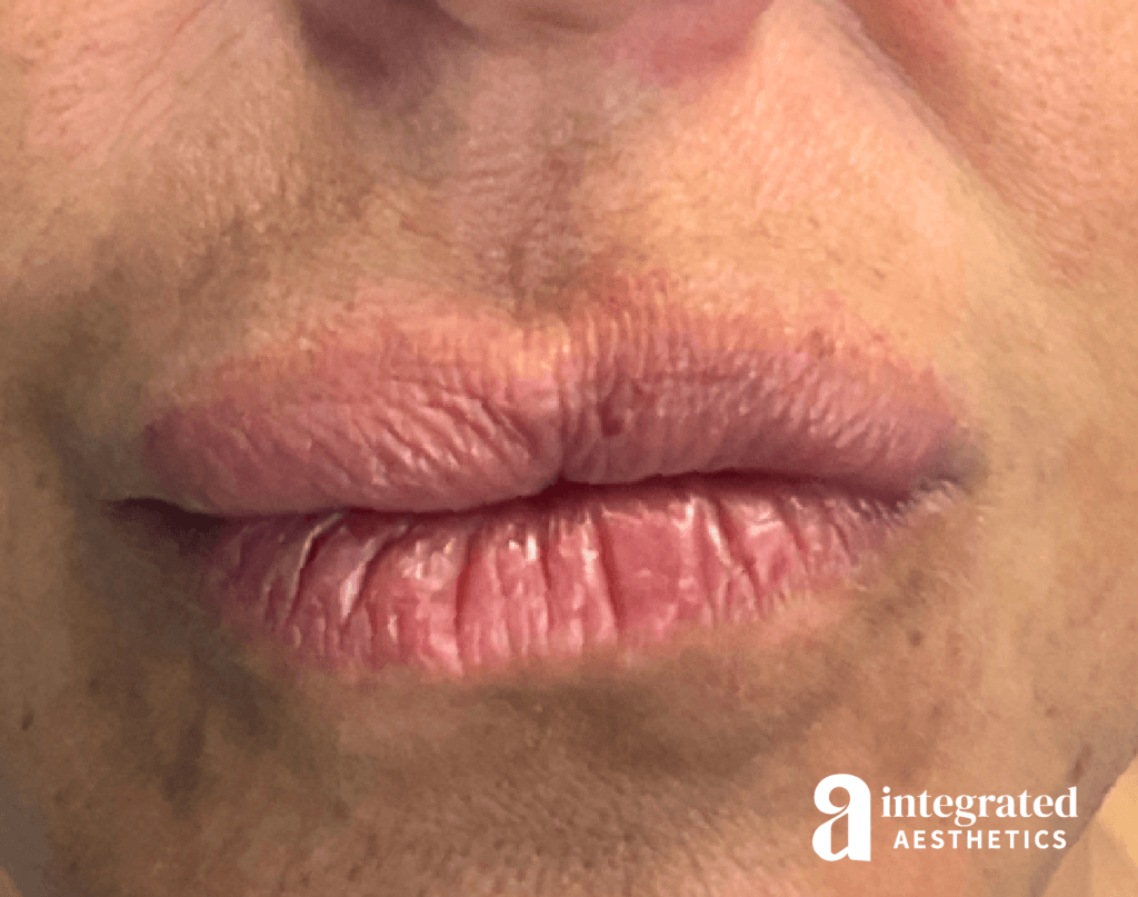 Resolved Aesthetic Complications