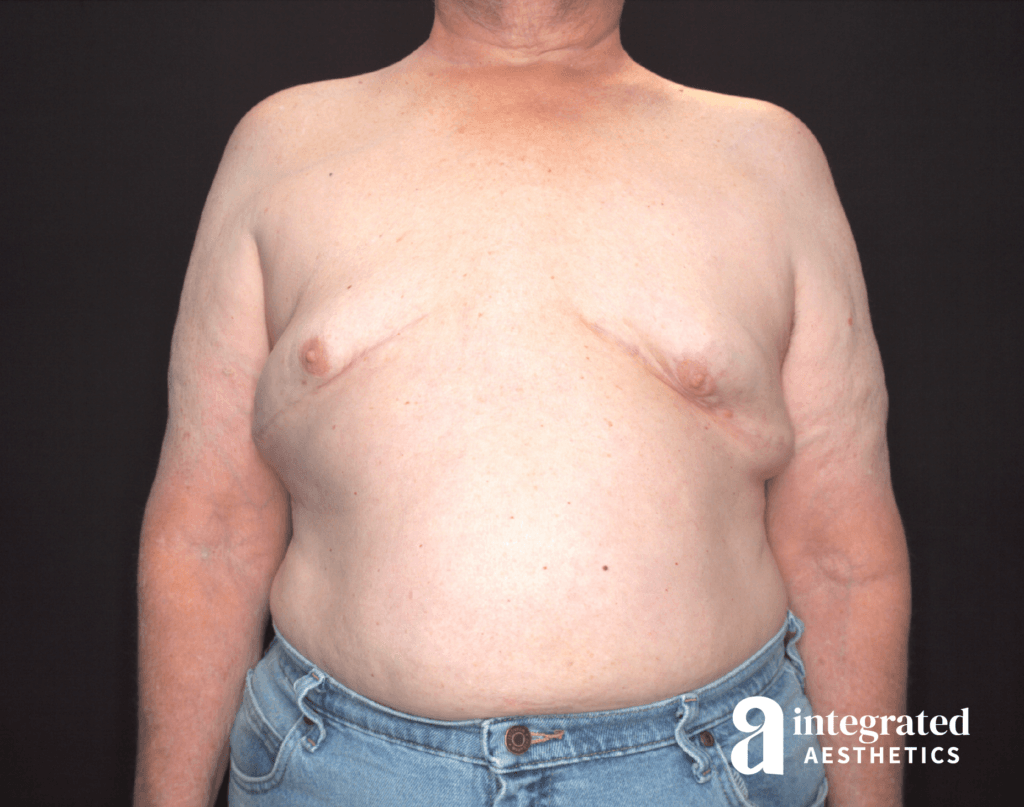 Gynecomastia