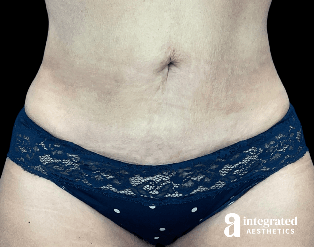 QuantumRF and Morpheus8 (Body)