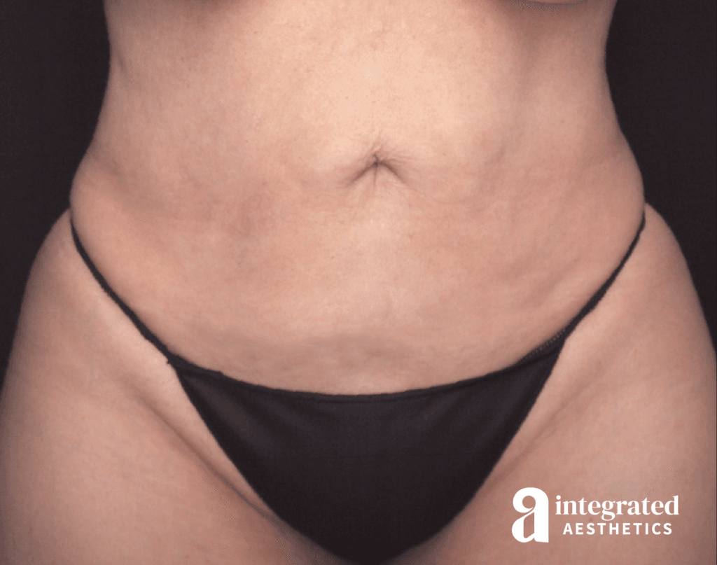 QuantumRF and Morpheus8 (Body)