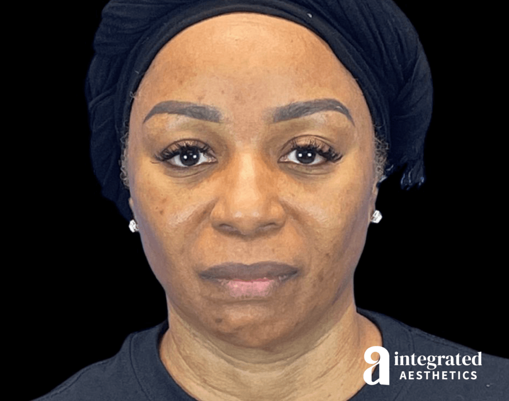 Chemical Peel
