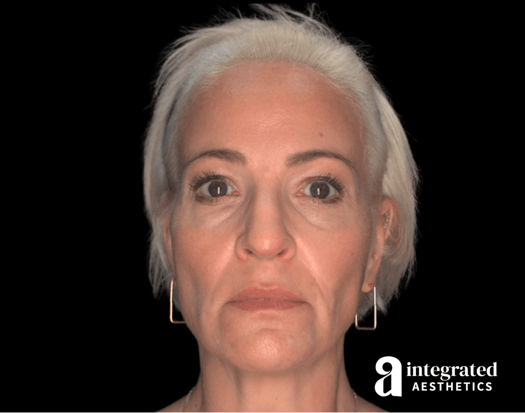 Dermal Fillers