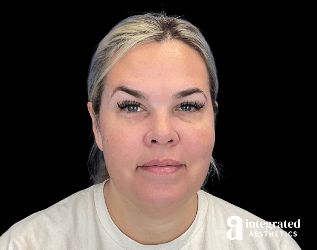 Chemical Peel