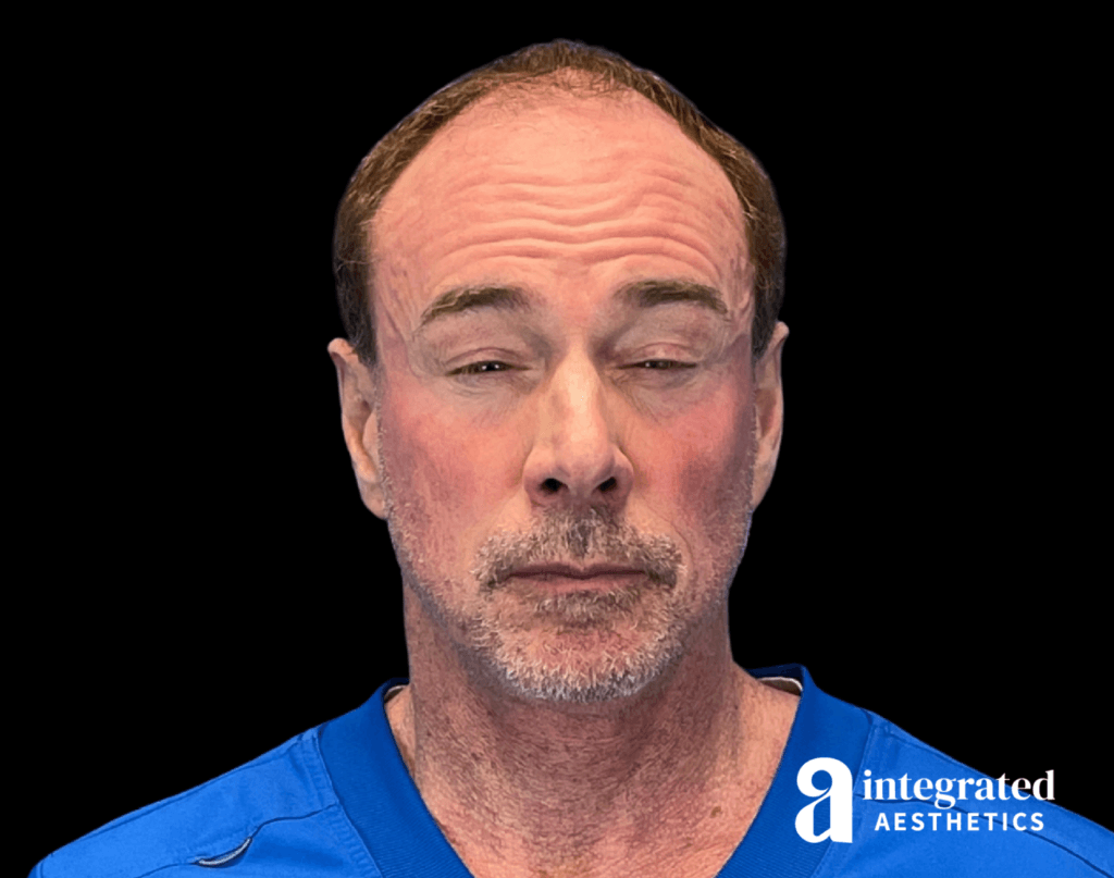 Wrinkle Relaxers