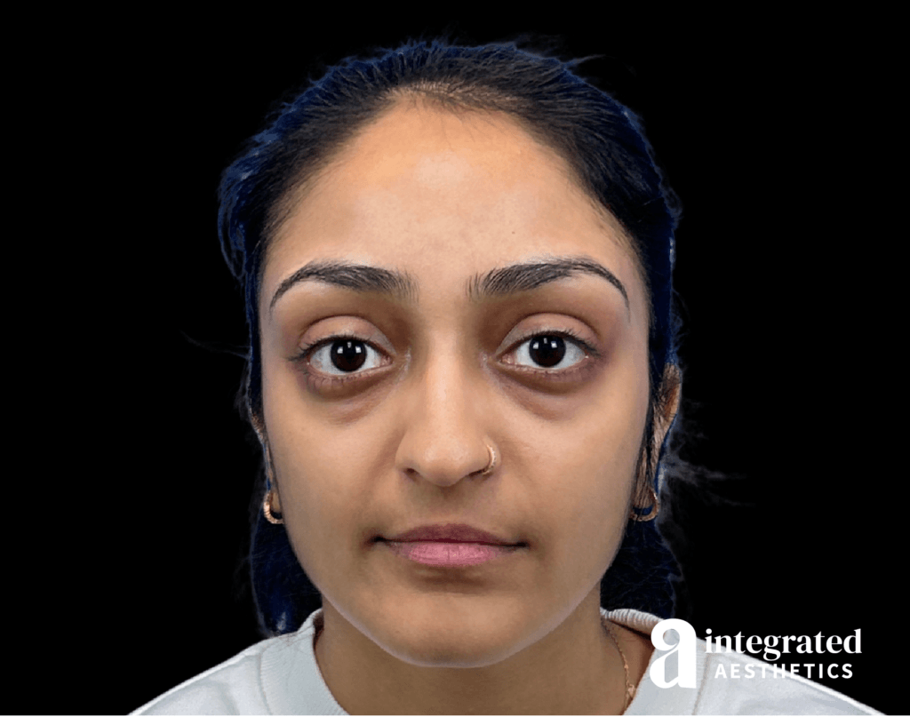 Blepharoplasty