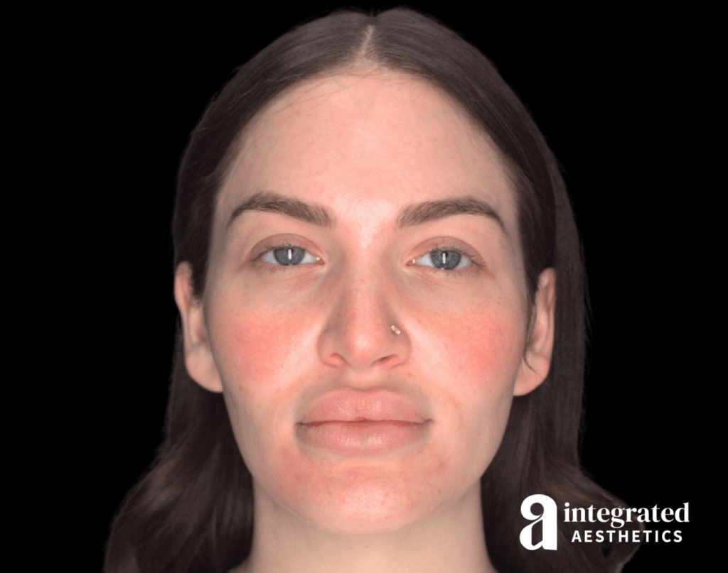 Resolved Aesthetic Complications