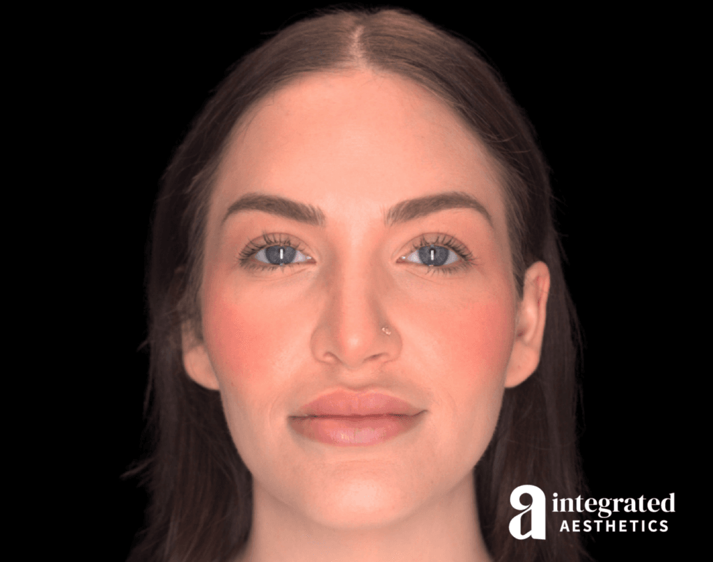 Resolved Aesthetic Complications