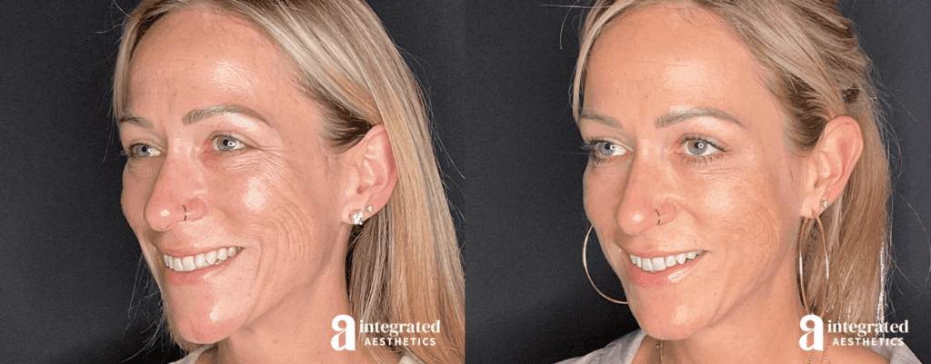 Before and 2 weeks after Radiesse and Botox