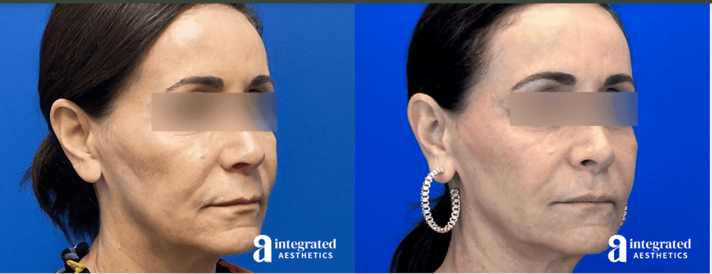 Dr. Melissa Chiang treated this 58-year-old patient’s midface, chin, and lips with the biostimulator Radiesse