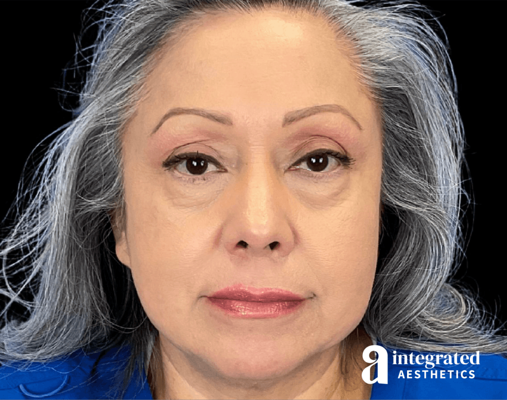Blepharoplasty
