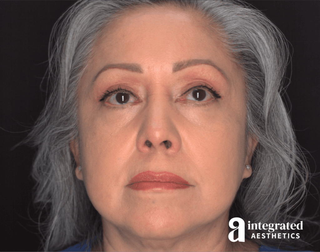 Blepharoplasty